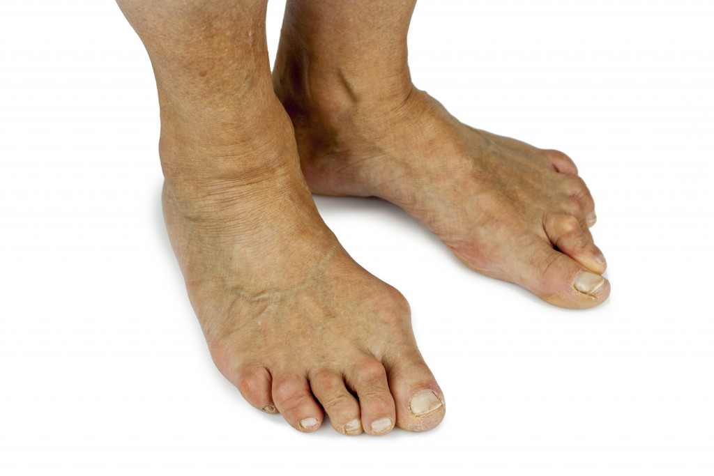 Whole Foot Pain - Buderim Podiatry, Sunshine Coast podiatrist, foot care